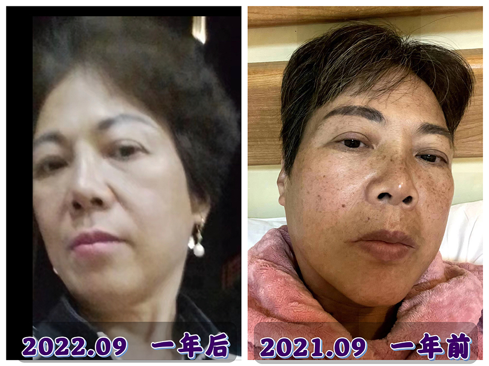 吳美嬌女士用了手擦塑美精油+手擦五行舒美.水四季套裝10個(gè)月后的美麗蛻變！